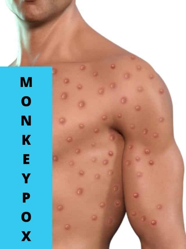 Monkeypox virus outbreak- Know symptoms and how to avoid