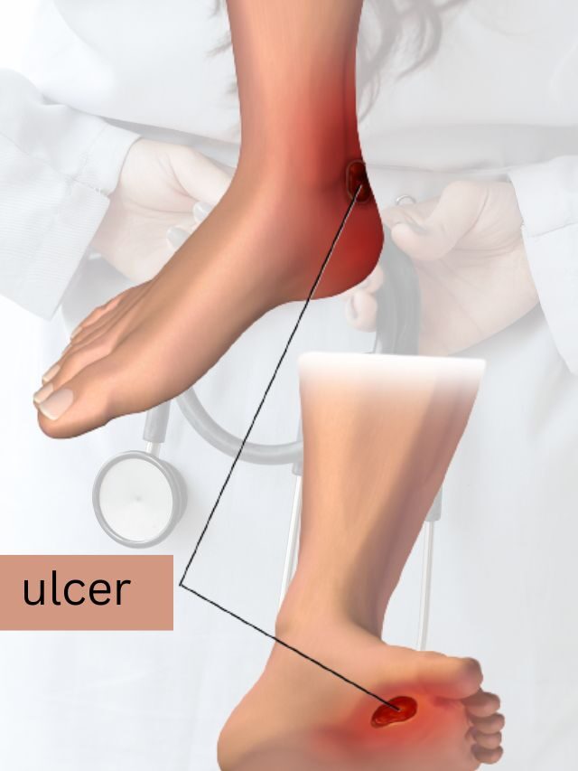 How to take care of diabetic foot ulcer